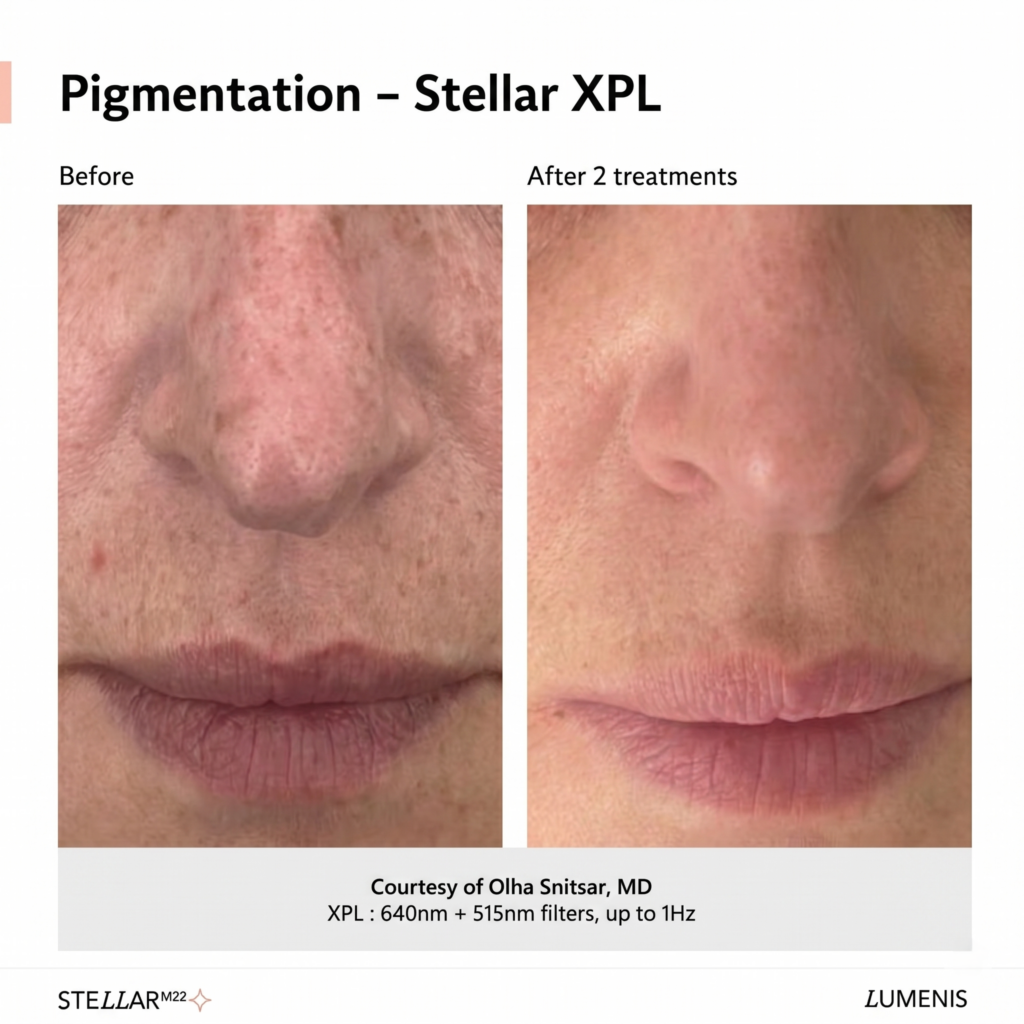 Before and after a Lumenis Stellar M22 IPL photofacial showing reduced facial pigmentation after two treatments